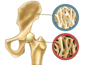 What Is Osteopenia?