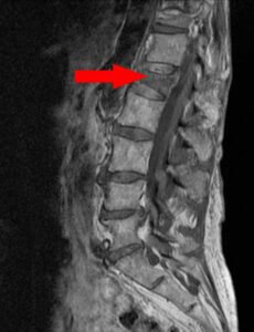 What Is Spinal Compression Fractures?