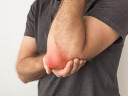 What is Bursitis Elbow?