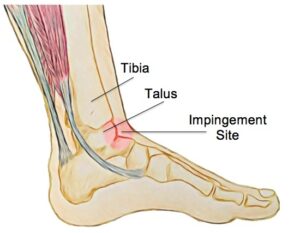 What is Front Ankle Pain?