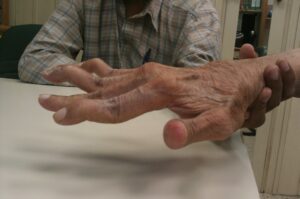 What is Swan Neck Deformity of the Finger?