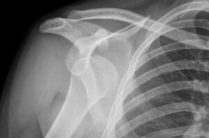 What is a Shoulder Dislocation?