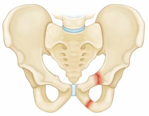 What Is A Crack In The Pelvic Bone And How To Treat It