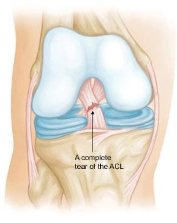 How to Treat an Anterior Cruciate Ligament Tear