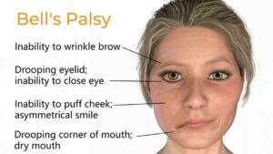 What is Bell's Palsy?