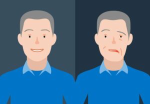 Bell's Palsy