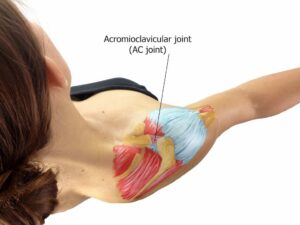 What Is AC Sprain And How Can You Recover?