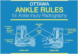 What Are Ottawa Ankle Rules?
