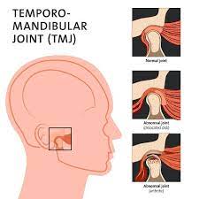 What is TMJ?