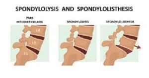 What Is Spondylolisthesis?