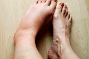What Is Lymphedema