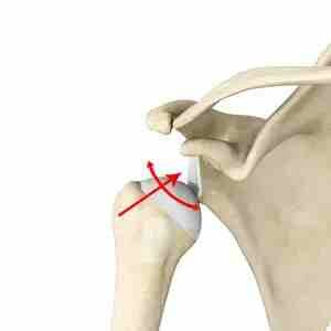 Surgical treatment multidirectional instability shoulder