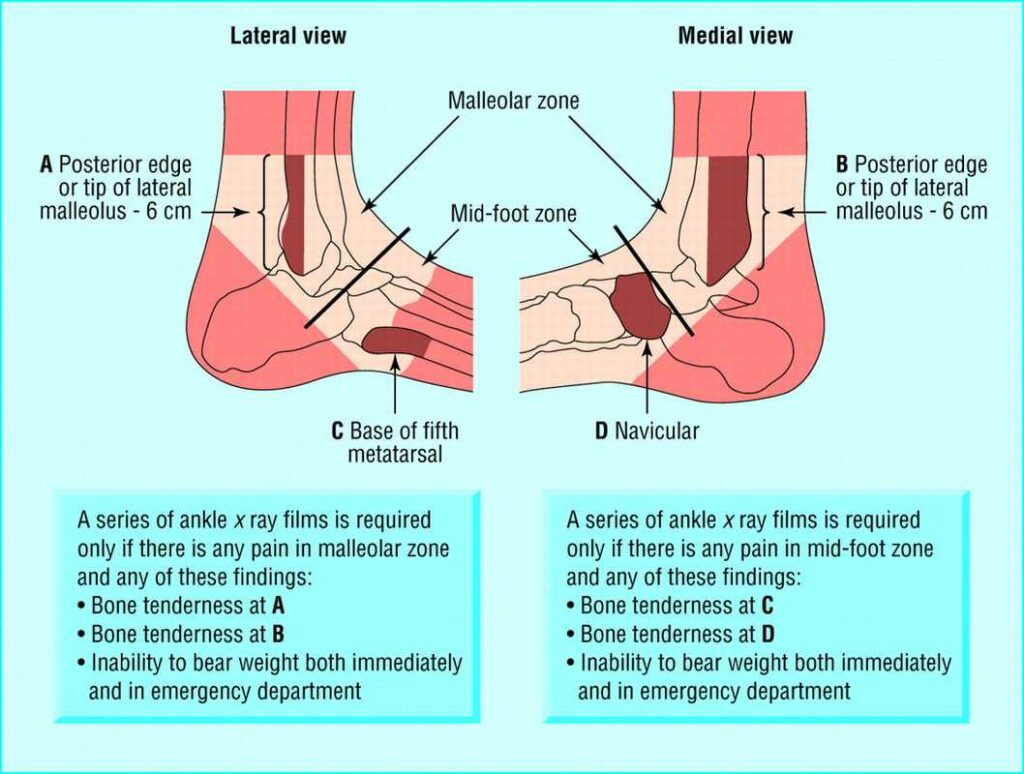 How to Use the Ottawa Ankle Rules to Assess Your Injuries