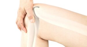 Recovery Of Knee Bursitis