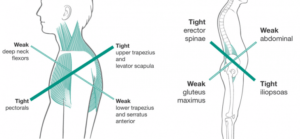 Upper and Lower Cross Syndrome: What You Need to Know