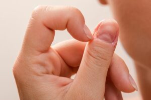 Dermatillomania OCD