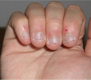 Nail Biting OCD