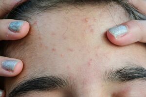 Burning Skin Anxiety Treatment