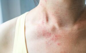 The Top 10 Treatments for OCD Skin Picking