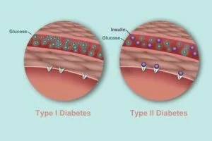 Diabetes Types