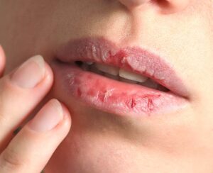 Is Skin Picking an OCD Symptom?