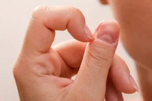 Manage Dermatillomania OCD